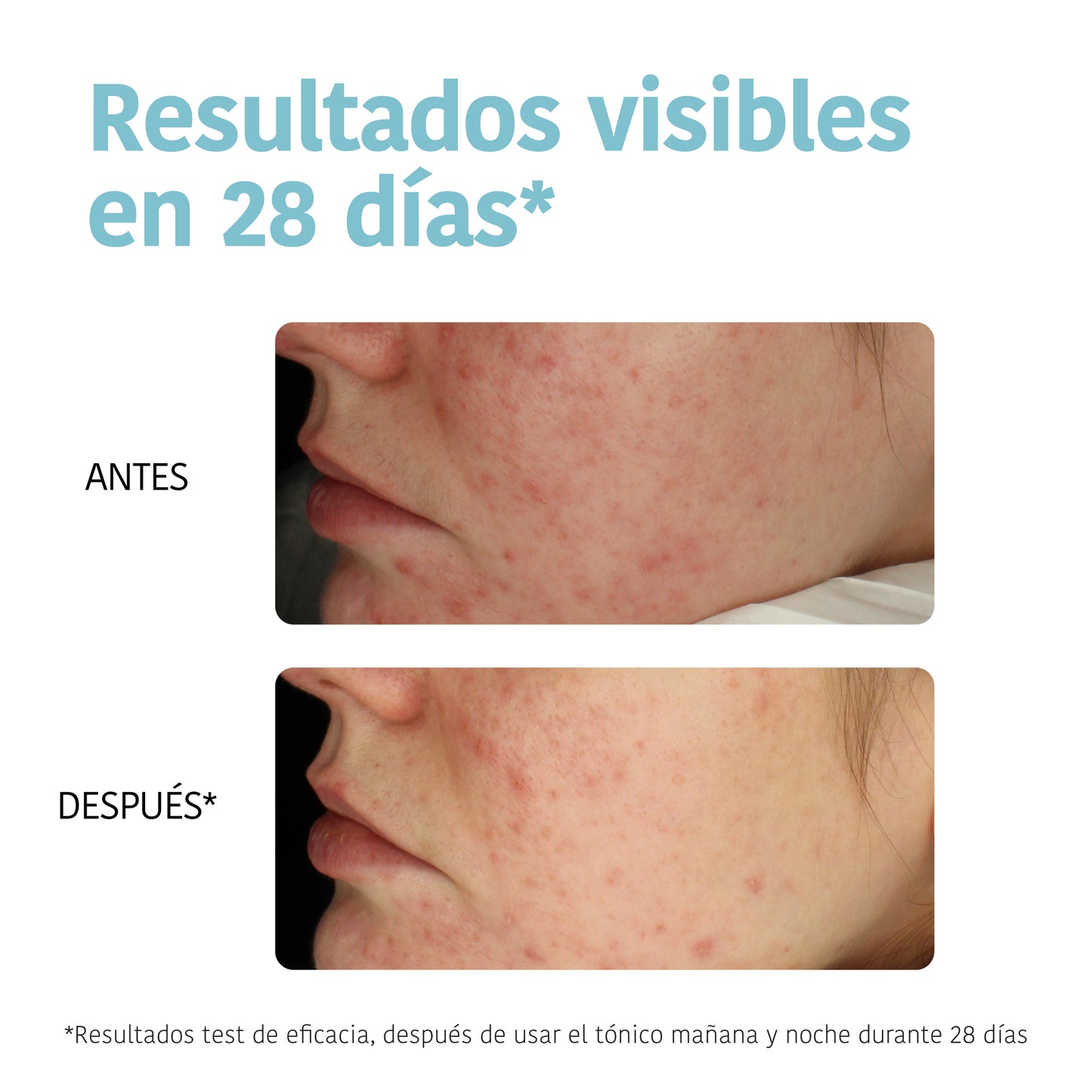 Disques toniques exfoliants - Acné