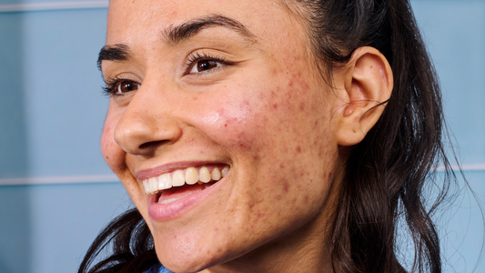 ¿Qué hábitos ayudan a cicatrizar los granos? Guía completa para recuperar tu piel