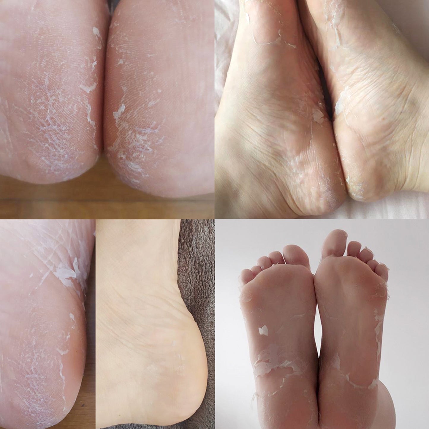 Chaussettes Peeling et Exfoliantes à l'Acide Glycolique
