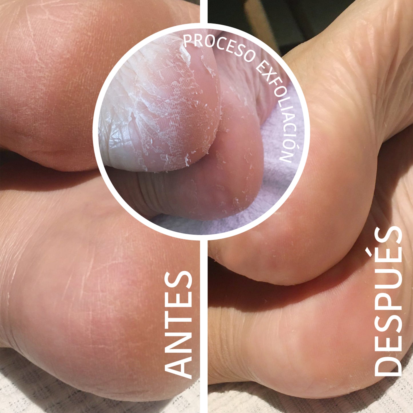 Chaussettes Peeling et Exfoliantes à l'Acide Glycolique