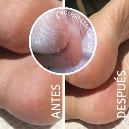 Chaussettes Peeling et Exfoliantes à l'Acide Glycolique