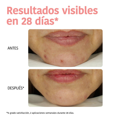 Masque peeling à l'acide glycolique