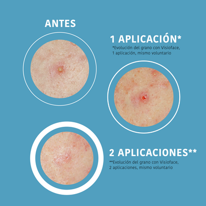 Patchs anti-boutons SOS à l'acide salicylique