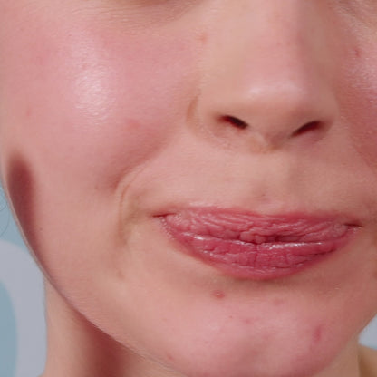 Patchs anti-boutons FUN à l'Acide Salicylique